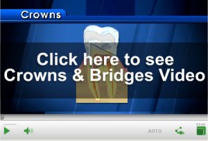 Crown & Bridge Video
