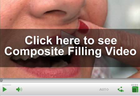 Composite Filling Video Link