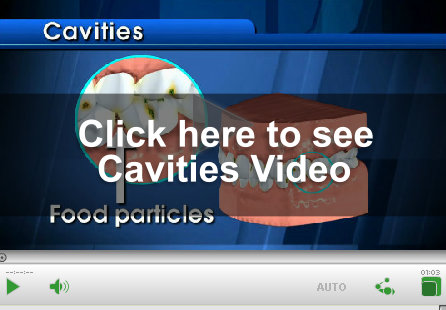 Cavities Video