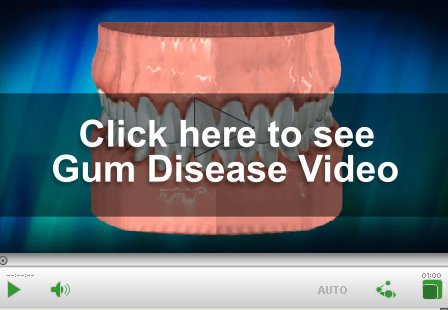 Gum Disease Video