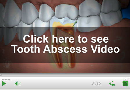 Tooth Abscess Video